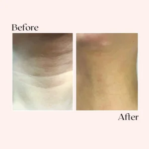 Tiworld™ Micro-Needling Infusion System