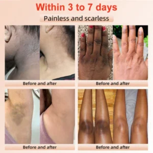 Fivfivgo™ Purifying Exfoliating Gel for Acanthosis Nigricans, Exfoliation