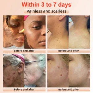 Fivfivgo™ Purifying Exfoliating Gel for Acanthosis Nigricans, Exfoliation