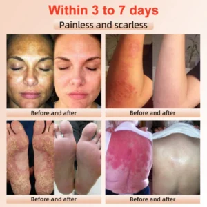 Fivfivgo™ Purifying Exfoliating Gel for Acanthosis Nigricans, Exfoliation