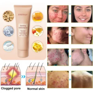 Fivfivgo™ Purifying Exfoliating Gel for Acanthosis Nigricans, Exfoliation