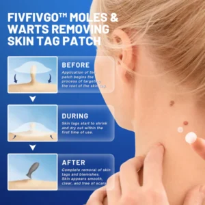 Fivfivgo™ Moles & Warts Removing Skin Tag Patch