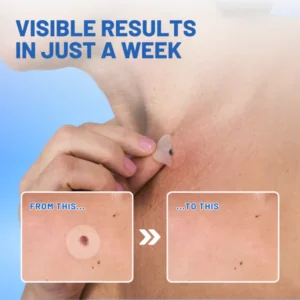Fivfivgo™ Moles & Warts Removing Skin Tag Patch
