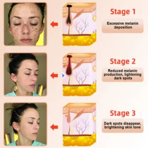 Fivfivgo™ Purifying Exfoliating Gel for Acanthosis Nigricans, Exfoliation