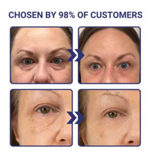 Facelift & Under Eye Tuck