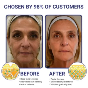 Facelift & Under Eye Tuck