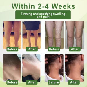 Outeny™ SwellFree Lymphatic Herbal Cream