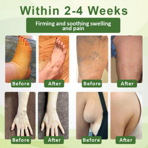 Outeny™ SwellFree Lymphatic Herbal Cream