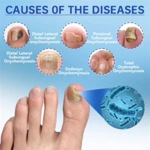 QIAWI™ Revolutionary High-Efficiency Light Therapy Device For Toenail Diseases