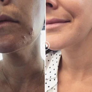 Fivfivgo™ WartsOff Instant Blemish Removal Cream – PREMIUM