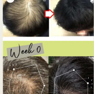 Anti-hair loss serum Buy 1 Get 1 Free