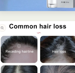 Anti-hair loss serum Buy 1 Get 1 Free