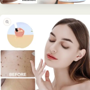 Mole removal and wart removal cream Buy 1 Get 1 Free