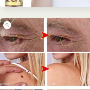 Mole removal and wart removal cream Buy 1 Get 1 Free