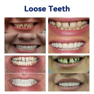 Advanced Customized Full Denture Set