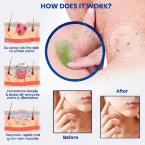 Oveallgo™ Ultra NatureErase Instant Mole & Spot Cream