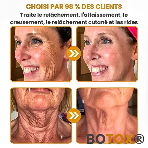 BOTOX® - Reduce Wrinkles in 2 Minutes - Fast and Effective Anti-Aging Serum
