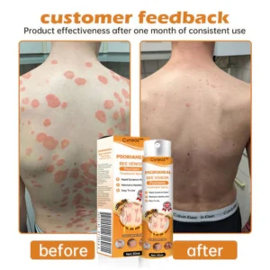 Cvreoz™ PsoriaHeal Bee Venom Psoriasis Treatment Spray
