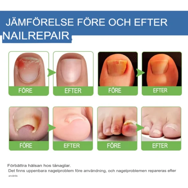 Fast-Acting Antifungal Nail Ointment