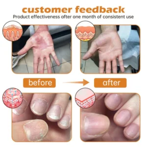 Cvreoz™ PsoriaHeal Bee Venom Psoriasis Treatment Spray