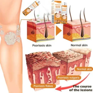 Cvreoz™ PsoriaHeal Bee Venom Psoriasis Treatment Spray