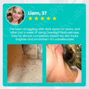Oveallgo™ Ultra NatureErase Instant Mole & Spot Cream