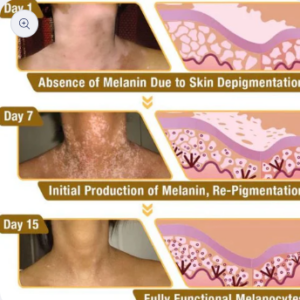 Fivfivgo™ BeeVenom Vitiligo ( 7 Days Result ) Treatment Cream